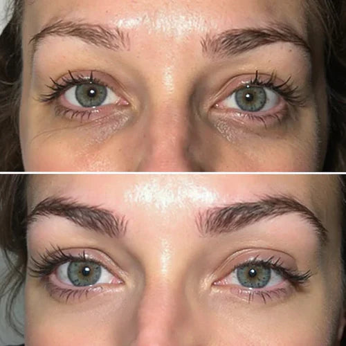 Korean Micro-needling  Eye Patches