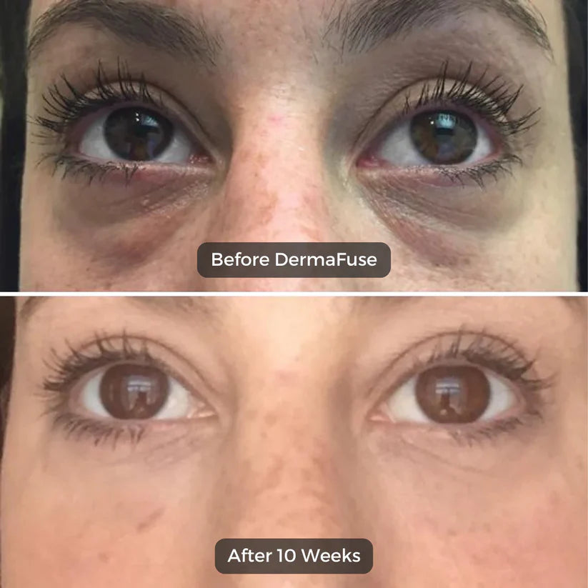 Korean Micro-needling  Eye Patches