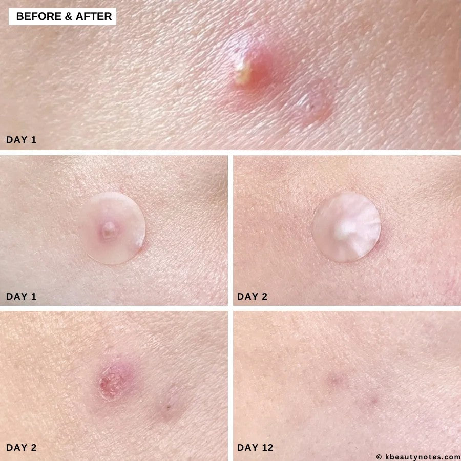 MicroPin Acne & Dark Spot Healing Patches