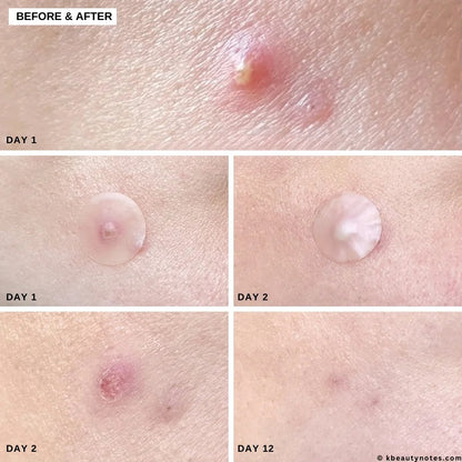 MicroPin Acne & Dark Spot Healing Patches