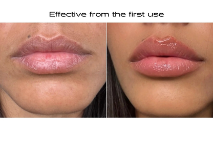 Plumping Microneedling Lip Patches